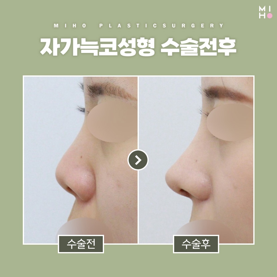 자가늑코수술 나에게 적합한 방식으로 관련 이미지 8