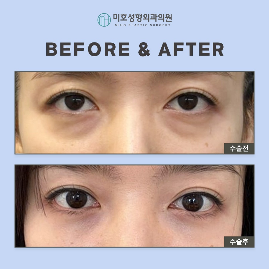 Miho Signature Lower Eyelid Fat Repositioning: The Beginning of Youth image 7