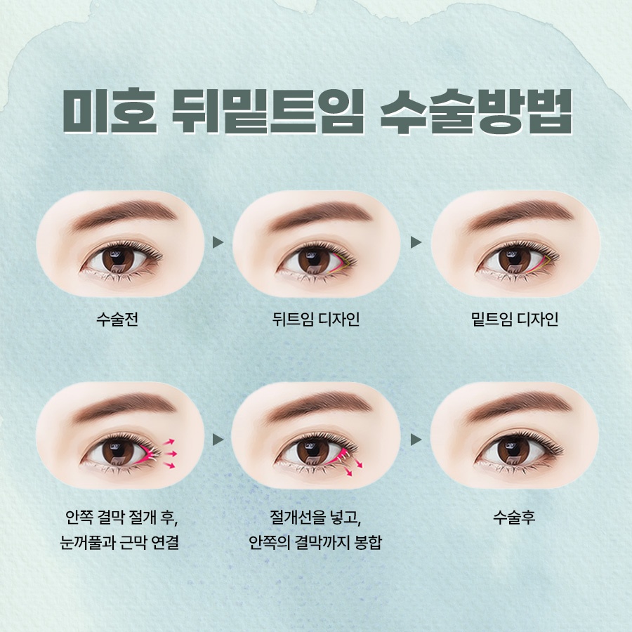 뒷트임밑트임후기 주의할 점 관련 이미지 5