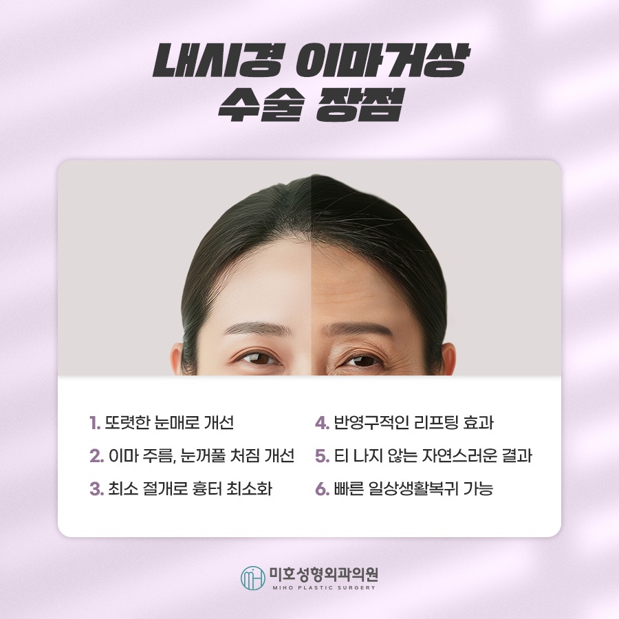 Forehead Lift Surgery Review: Tailored to Sagging Areas image 5