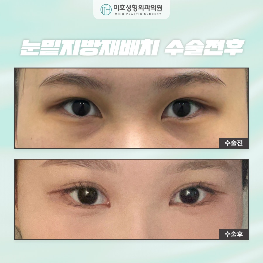 눈밑지방재배치후기 비교분석 하길 원한다면 관련 이미지 9