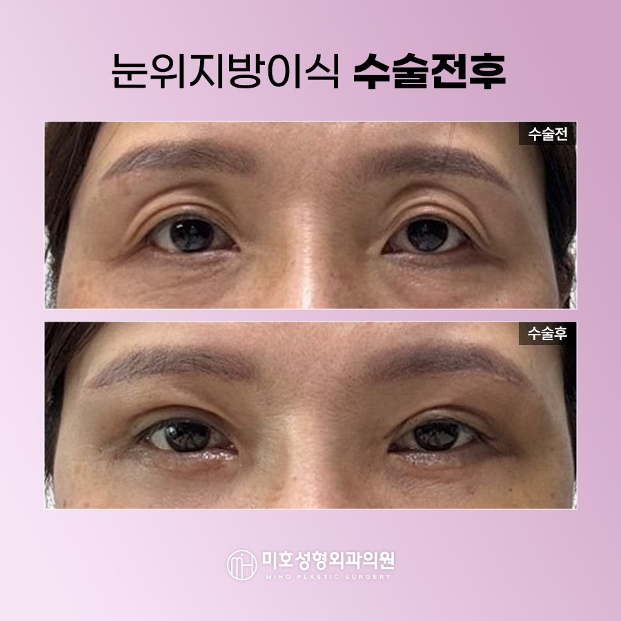 How to Naturally Improve Sunken Upper Eyelids image 8