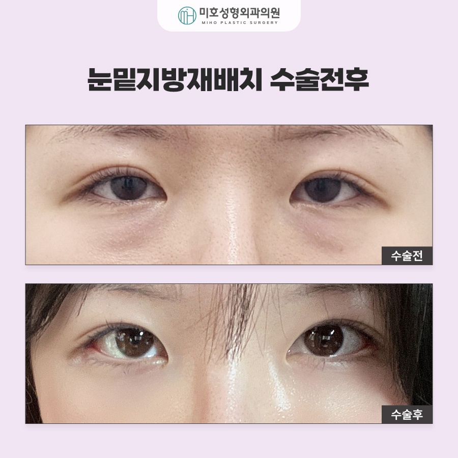 To Learn About Under-Eye Fat Graft Reviews, Methods, Swelling, and Recovery image 7