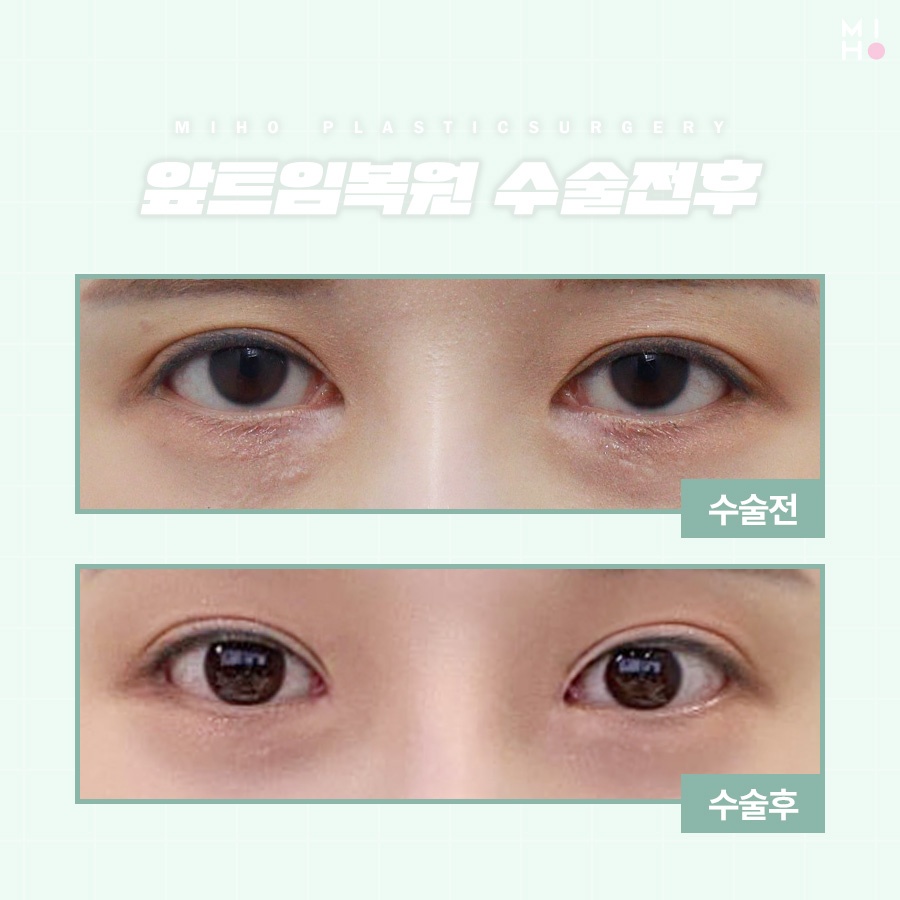 앞트임복원 필요한 상황을 확인하여 관련 이미지 7