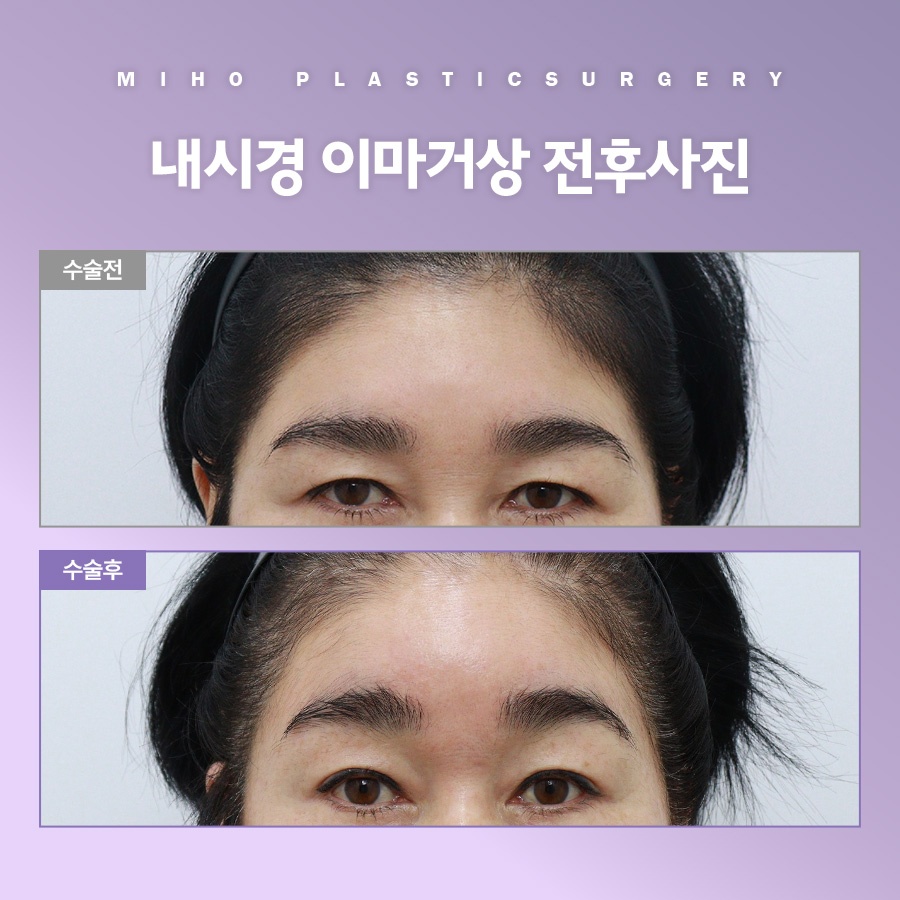 이마거상 비용 및 사후관리 팁 관련 이미지 7