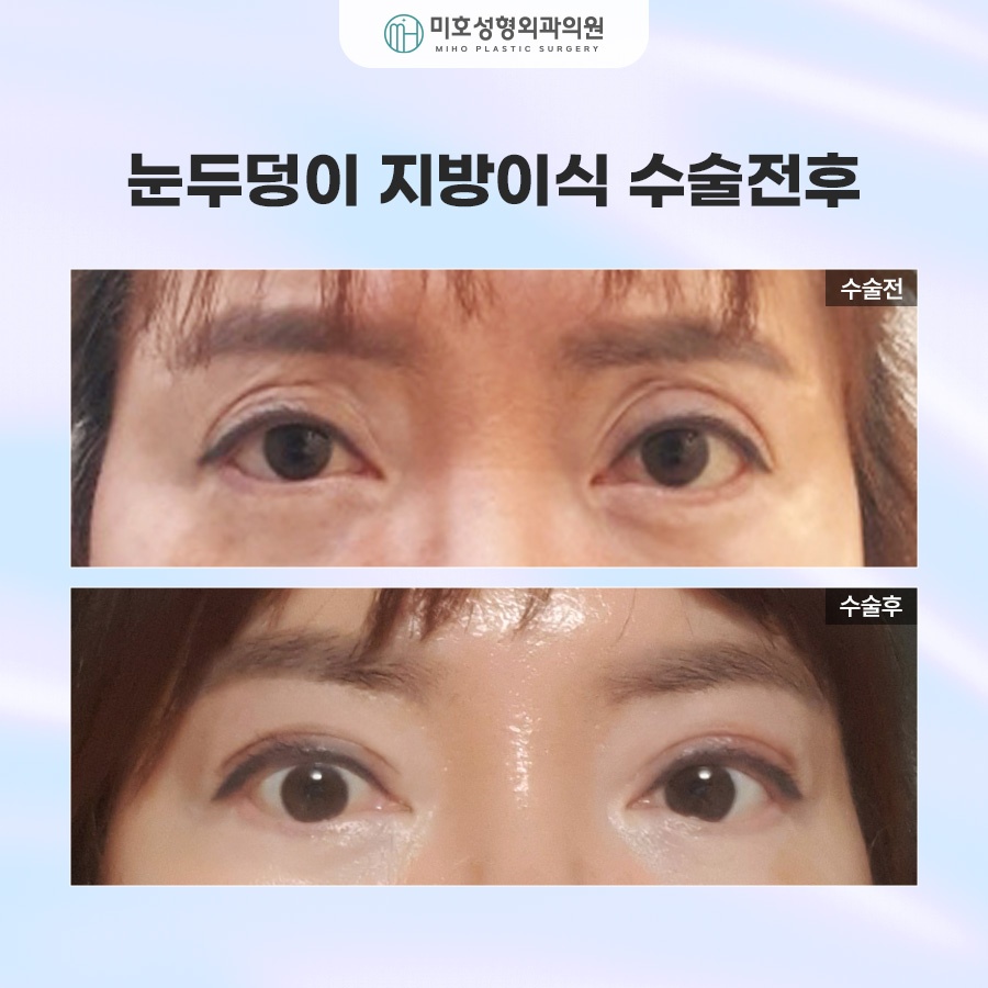 Upper Eyelid Fat Grafting to Improve Hollow Eyes and Make Them Look More Lively image 7