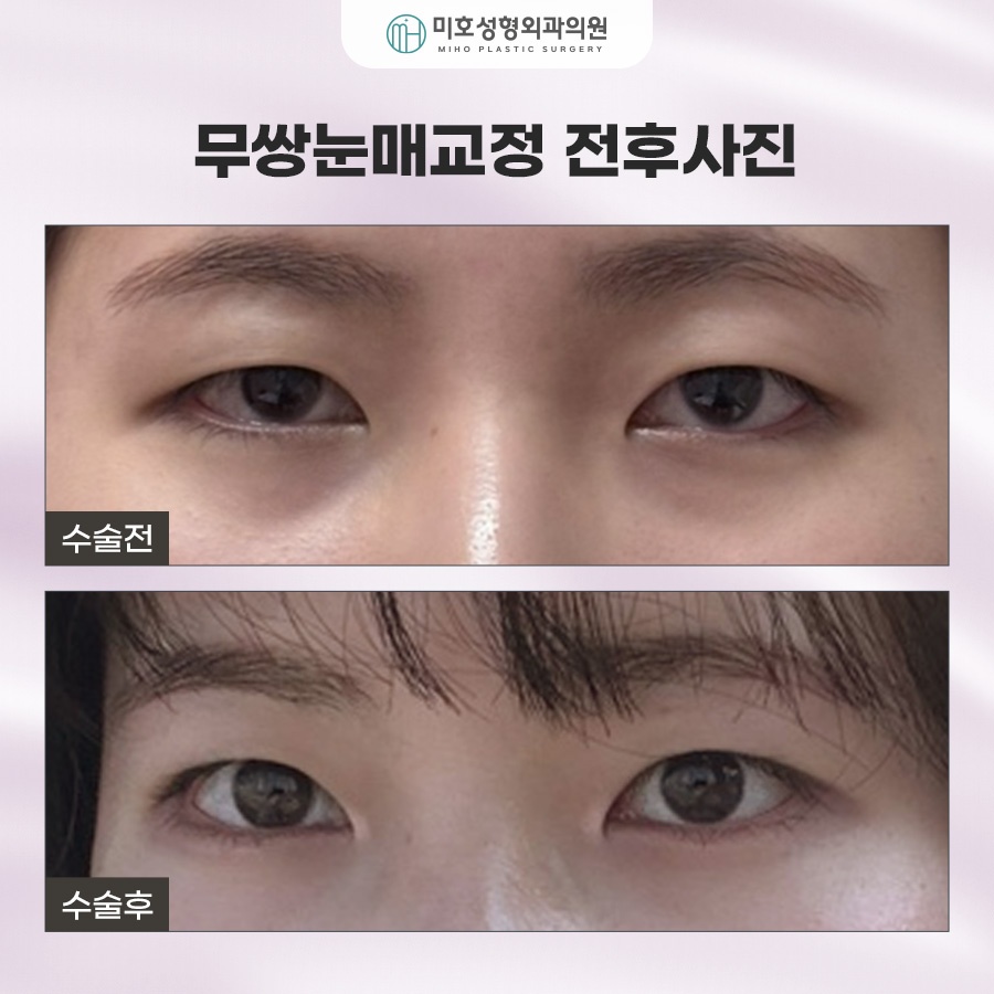 How to Make Your Eyes Bigger Without Double Eyelids: Ptosis Correction for Monolids image 7