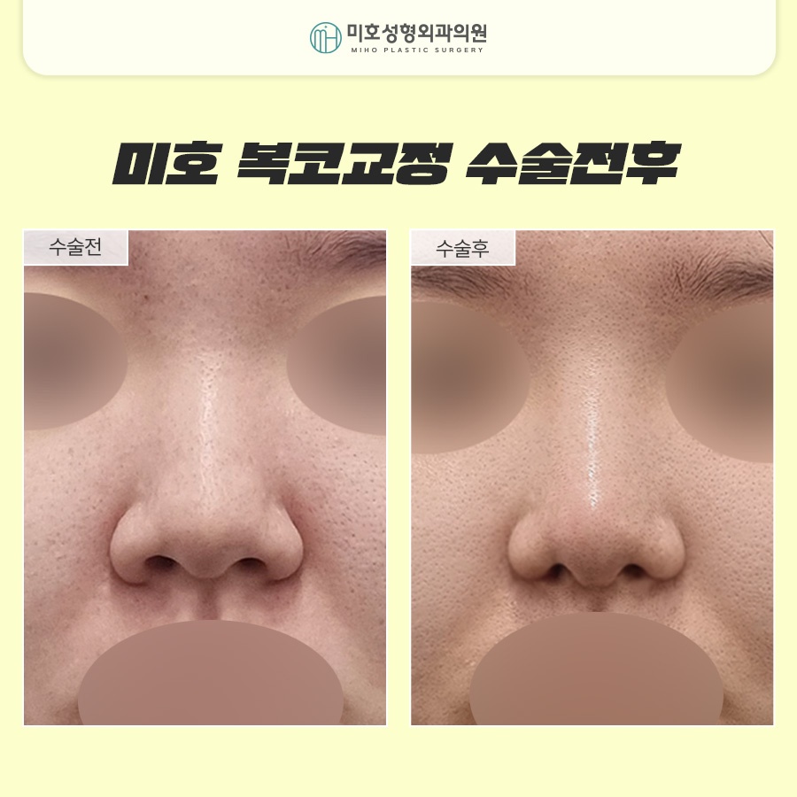 Naturally Improve the Bulbous Nose Complex image 8