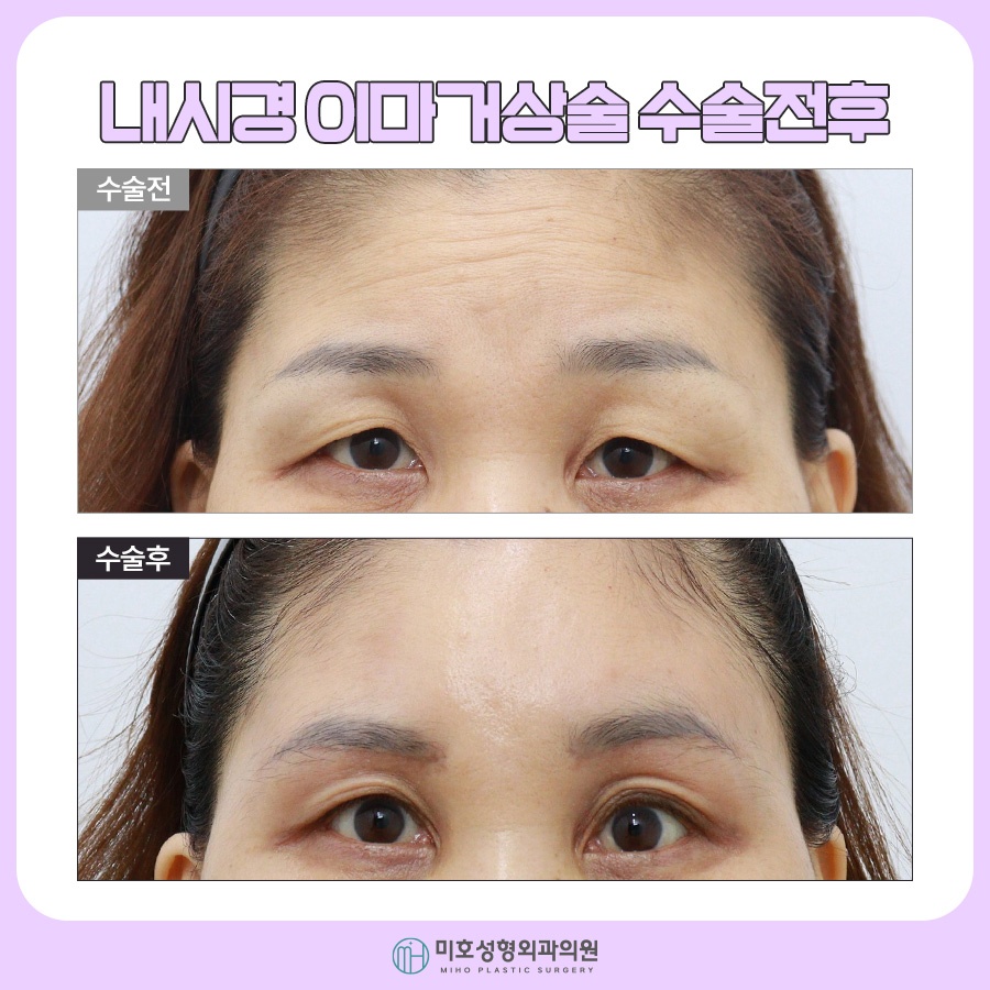 Why Choose Thread Lifting for a Brow Lift image 10