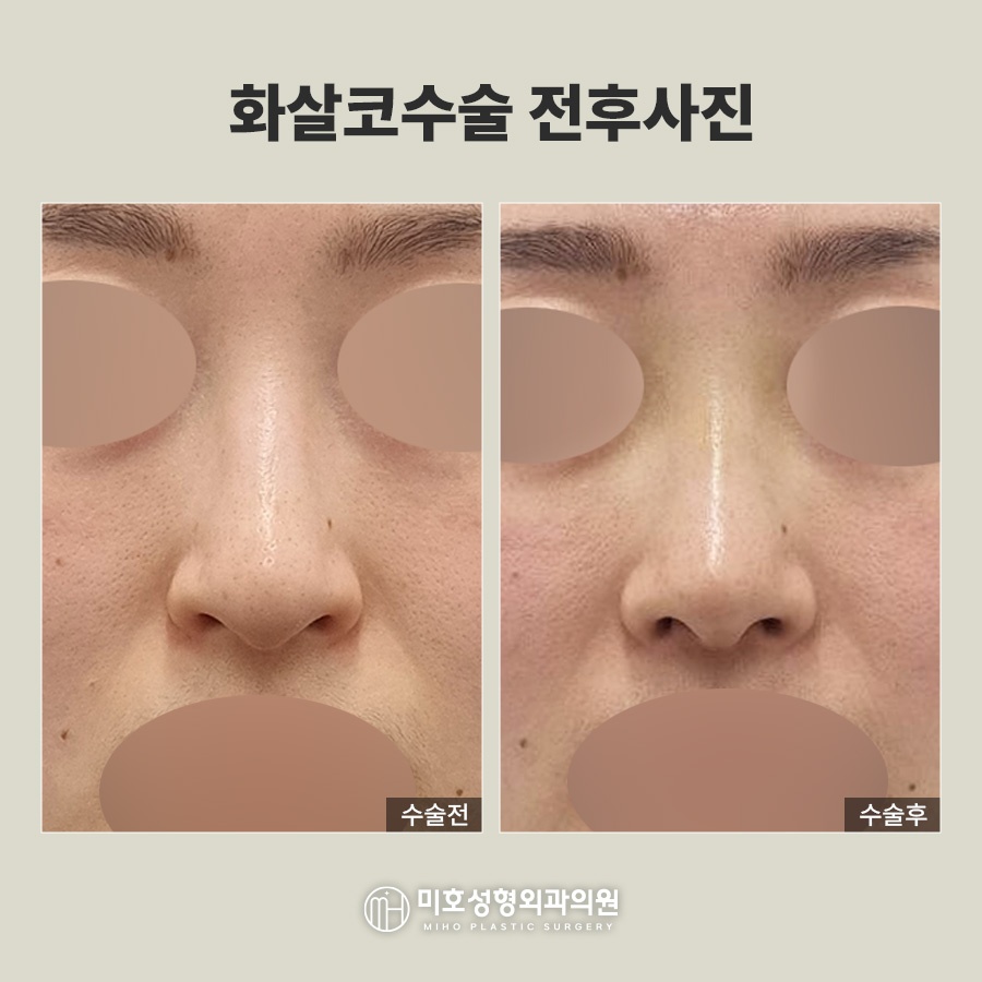화살코 처진 코끝 교정으로 세련된 인상 만들기 관련 이미지 9