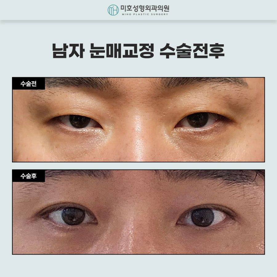 Naturally Defined Eyes with Male Eye-Shape Correction image 7