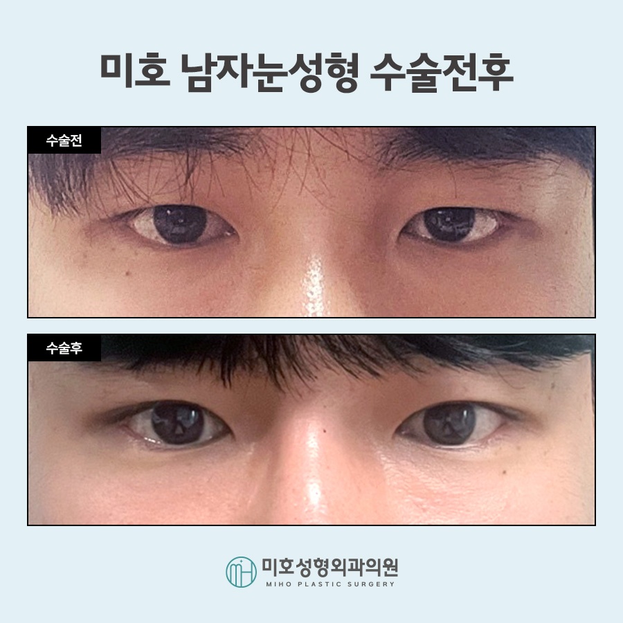 Focusing on a Natural Look in Male Eye Surgery image 7