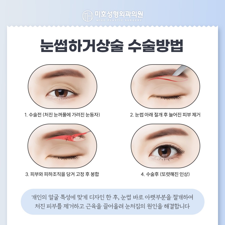 눈썹하거상술 처진 눈 개선 관련 이미지 4