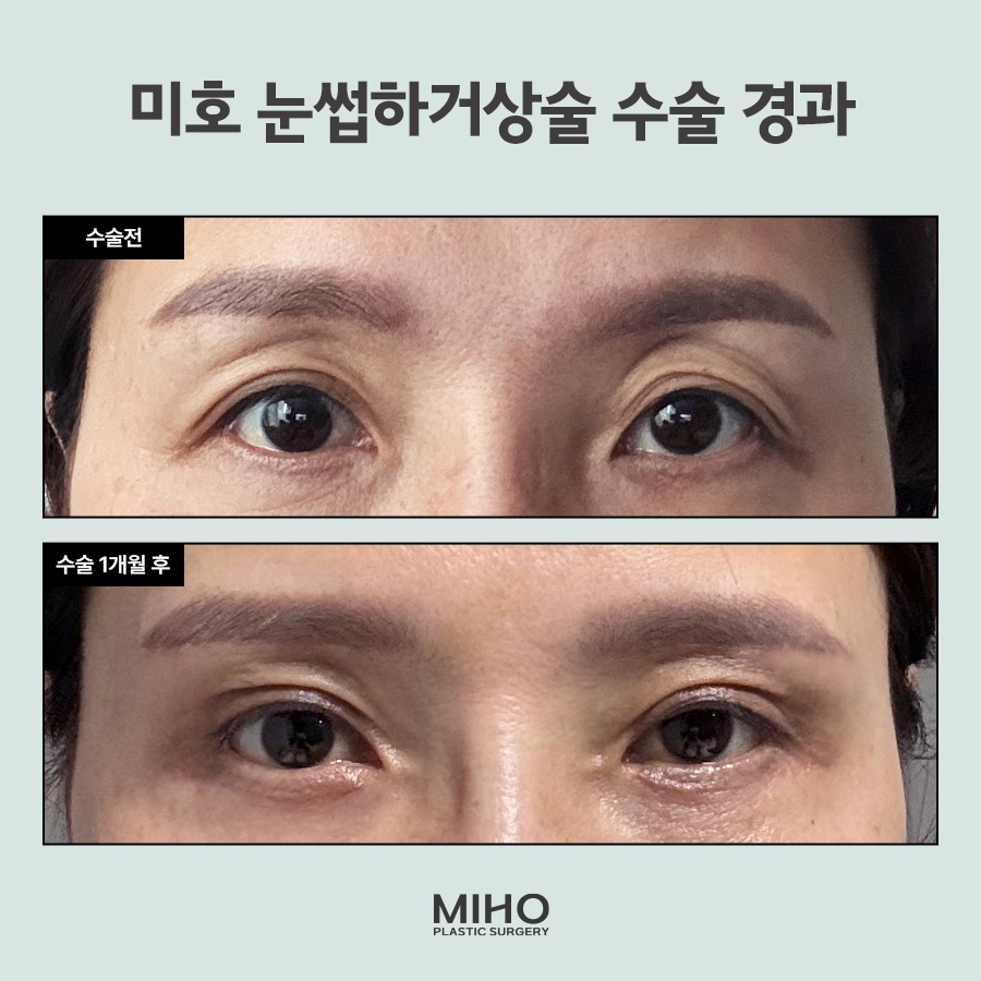 Sub-Brow Lift Scar, Cost, Recovery Process, Information, and Review image 7