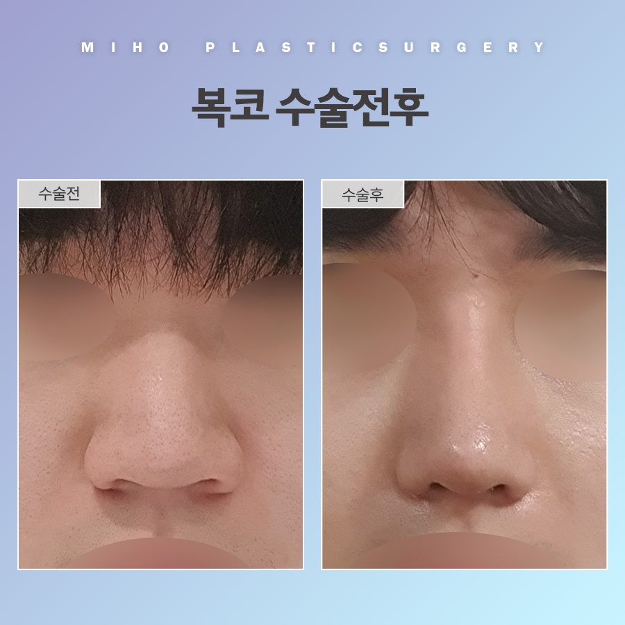 복코 교정 관상까지 좋아지려면 관련 이미지 9