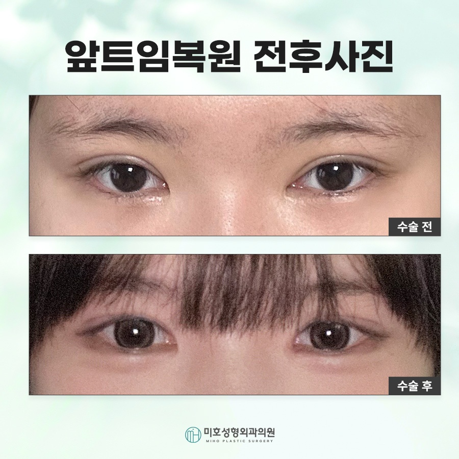 How Medial Canthoplasty Restoration Is Performed and Scar Care image 10