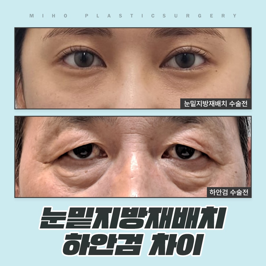 How to Choose Between Under-Eye Fat Repositioning and Lower Blepharoplasty image 1