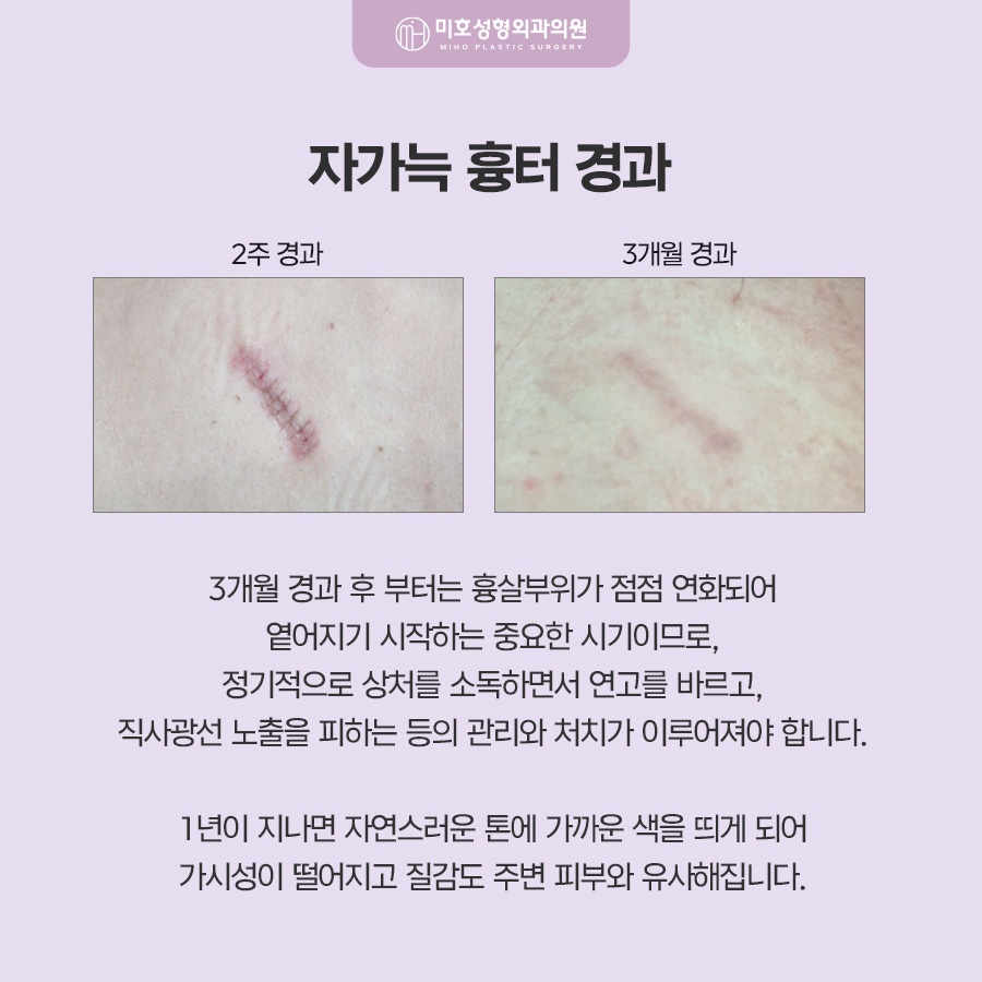 자가늑코수술 흉터와 통증이 걱정된다면 관련 이미지 6