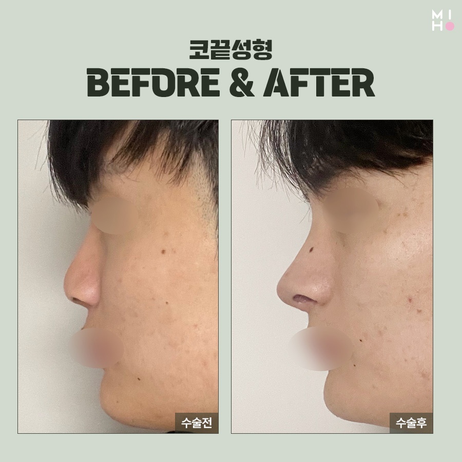 코끝연골묶기 복코 교정을 위한 과정 관련 이미지 9