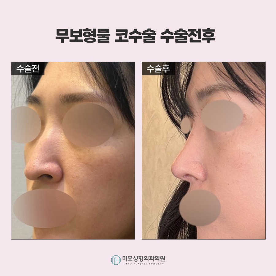 무보형물코수술 자연스러운 코라인을 위한 재료 선택과 확인사항 관련 이미지 7