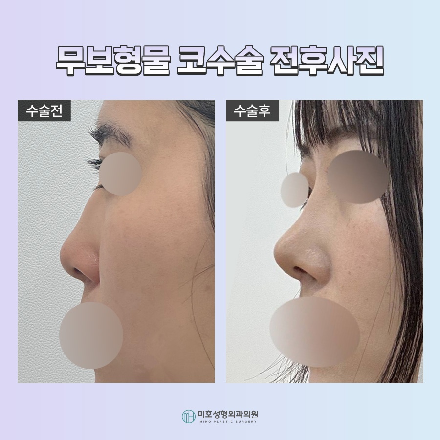A Natural Nose Using Autologous Tissue: Implant-Free Rhinoplasty image 8