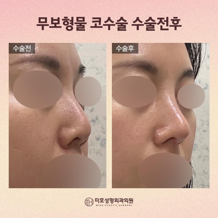 무보형물코수술 자연스레 보완하려면 관련 이미지 9