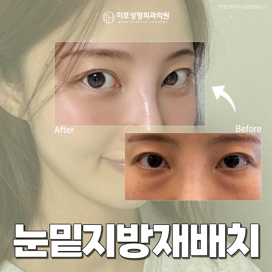 눈밑지방재배치 피로한 인상을 관련 이미지 1