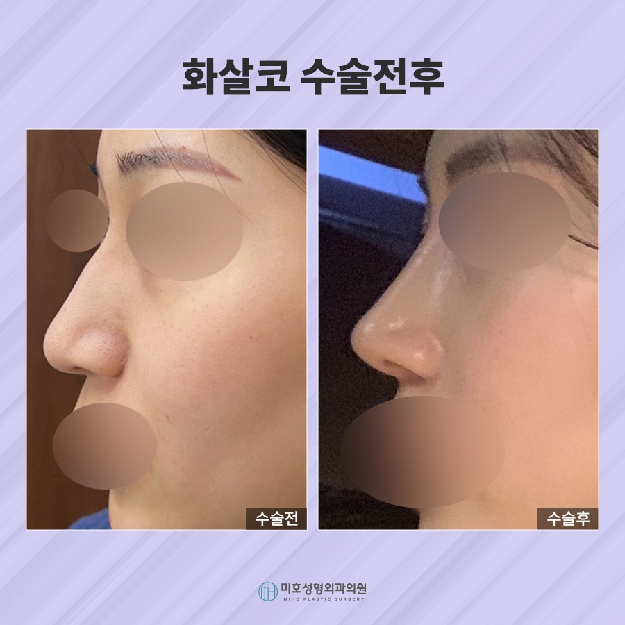 화살코 교정 방법 및 관리수칙 관련 이미지 8