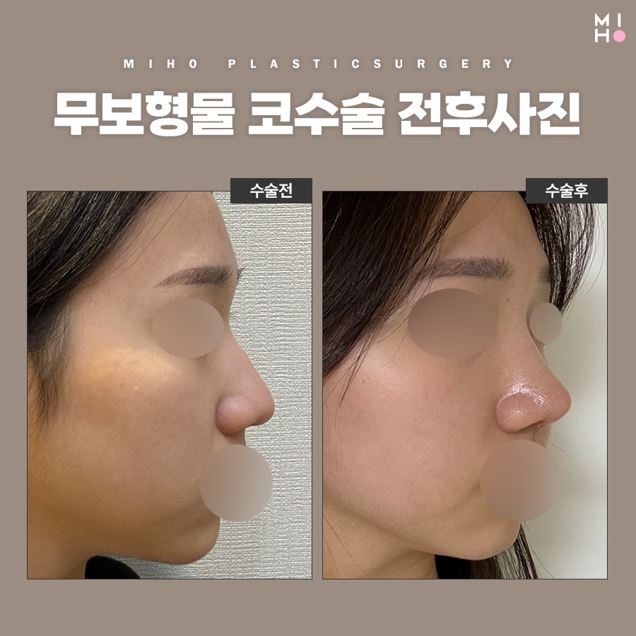 무보형물코수술 부담 없는 모양 개선 관련 이미지 7