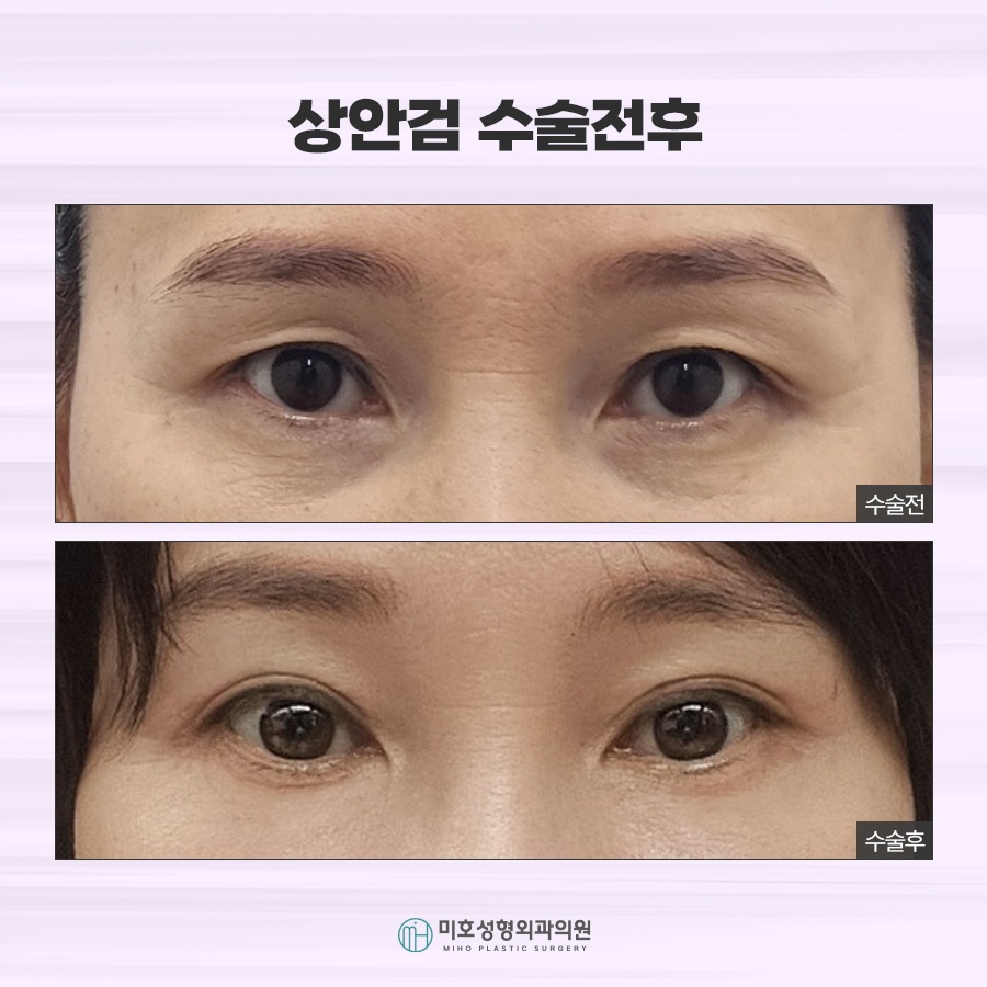 상하안검수술 처진 눈꺼풀 개선 방법 관련 이미지 8