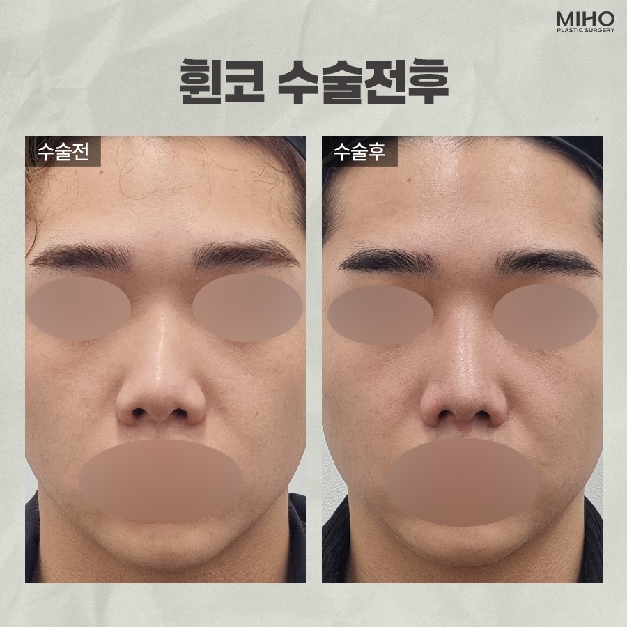 Experiencing the Difference in Crooked Nose Surgery image 10
