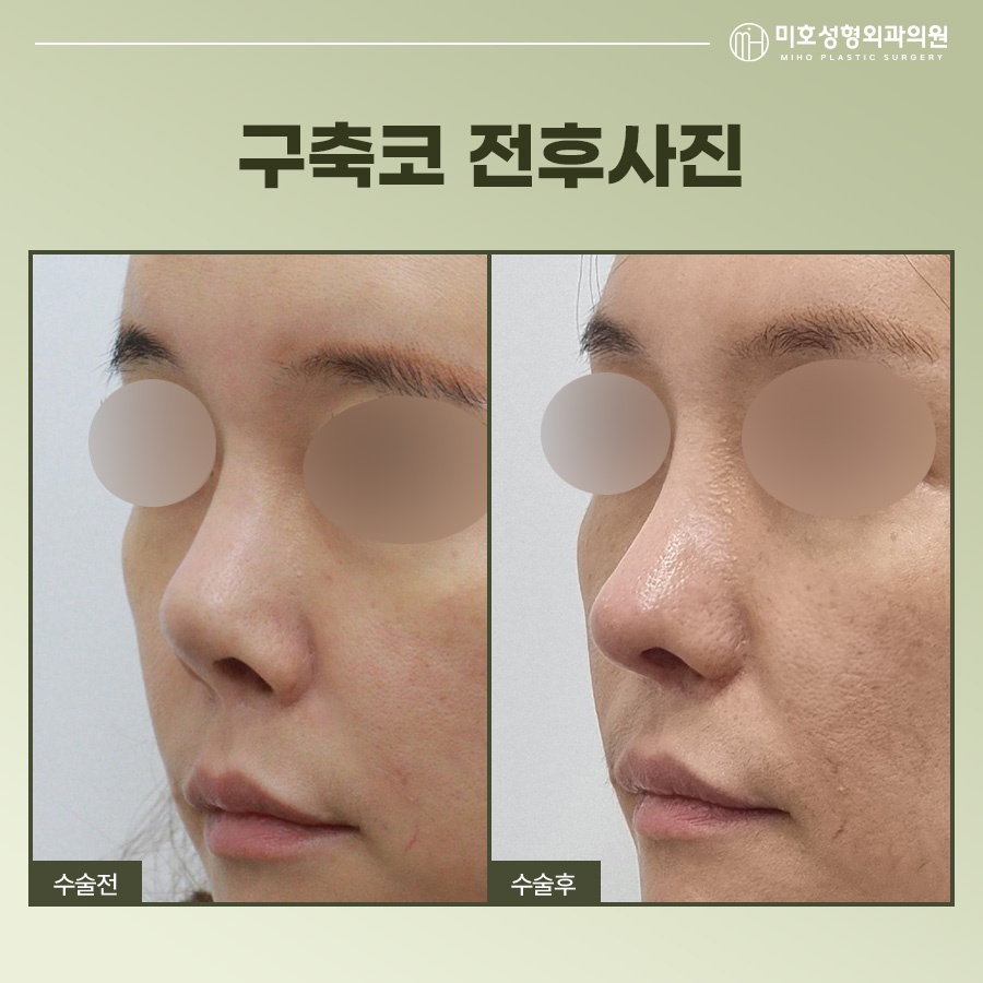 Identify the Cause of a Contracted Nose Before Attempting Revision image 10