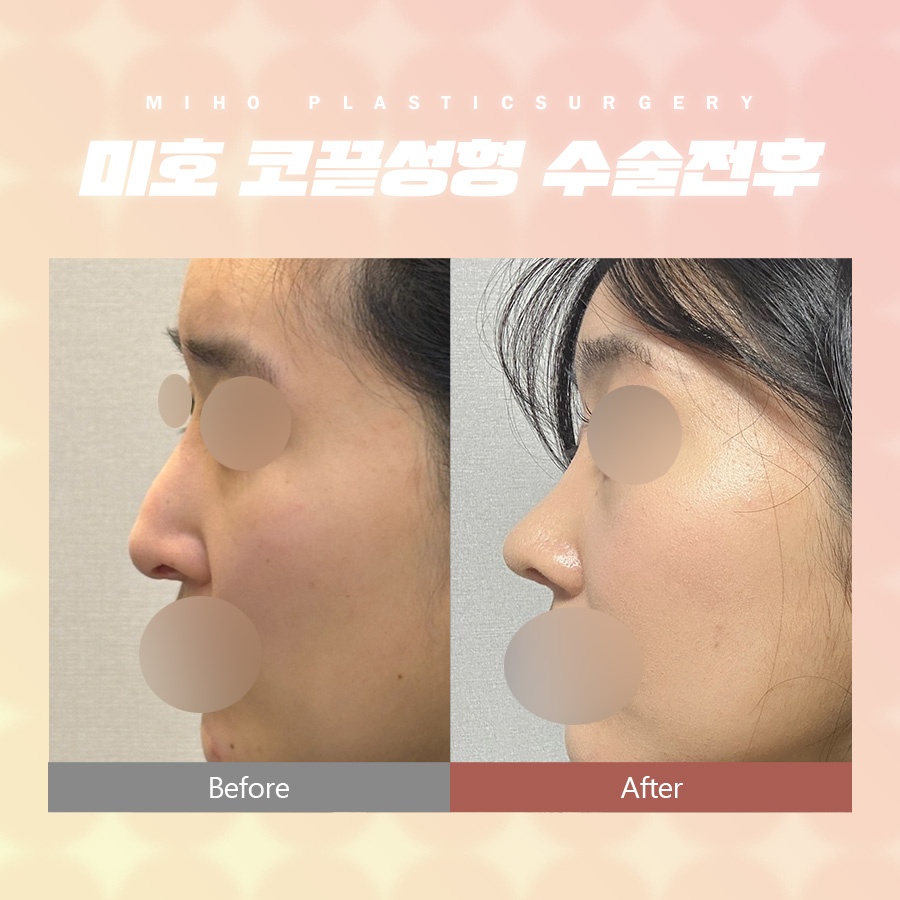 코끝성형 약간의 보완만으로 관련 이미지 9