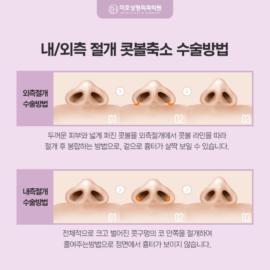 콧볼축소 고려 유형과 방식 관련 이미지 5