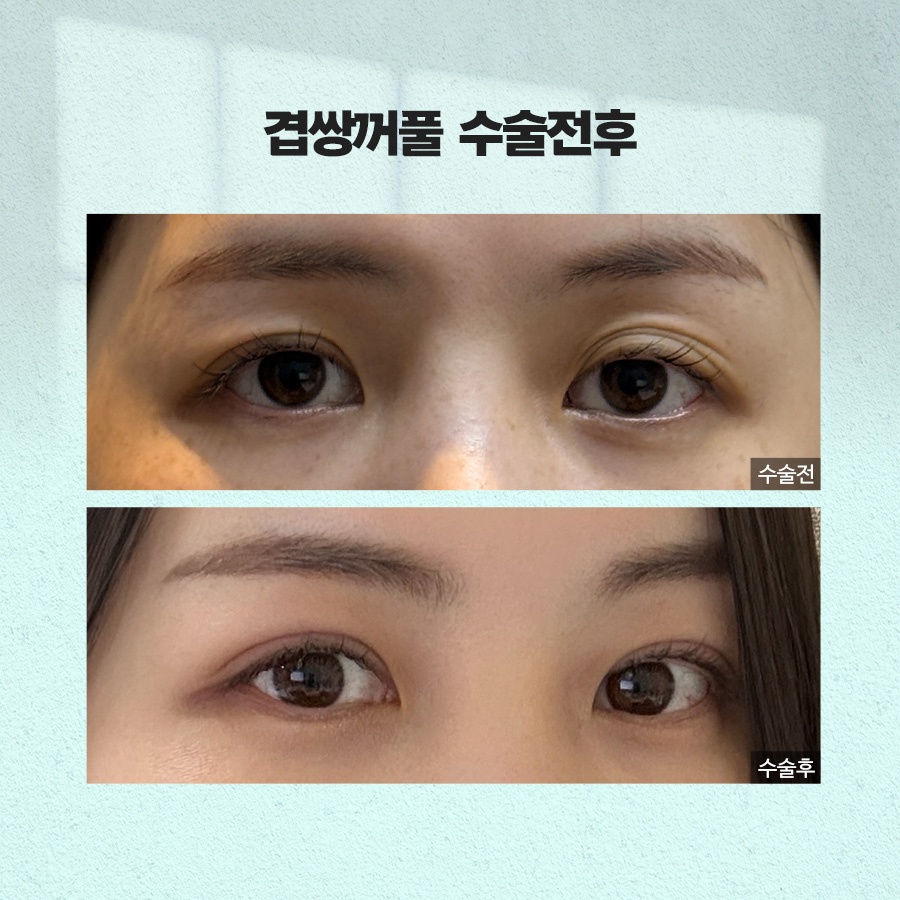 겹쌍꺼풀 생기는 이유와 없애는 방법까지 관련 이미지 7