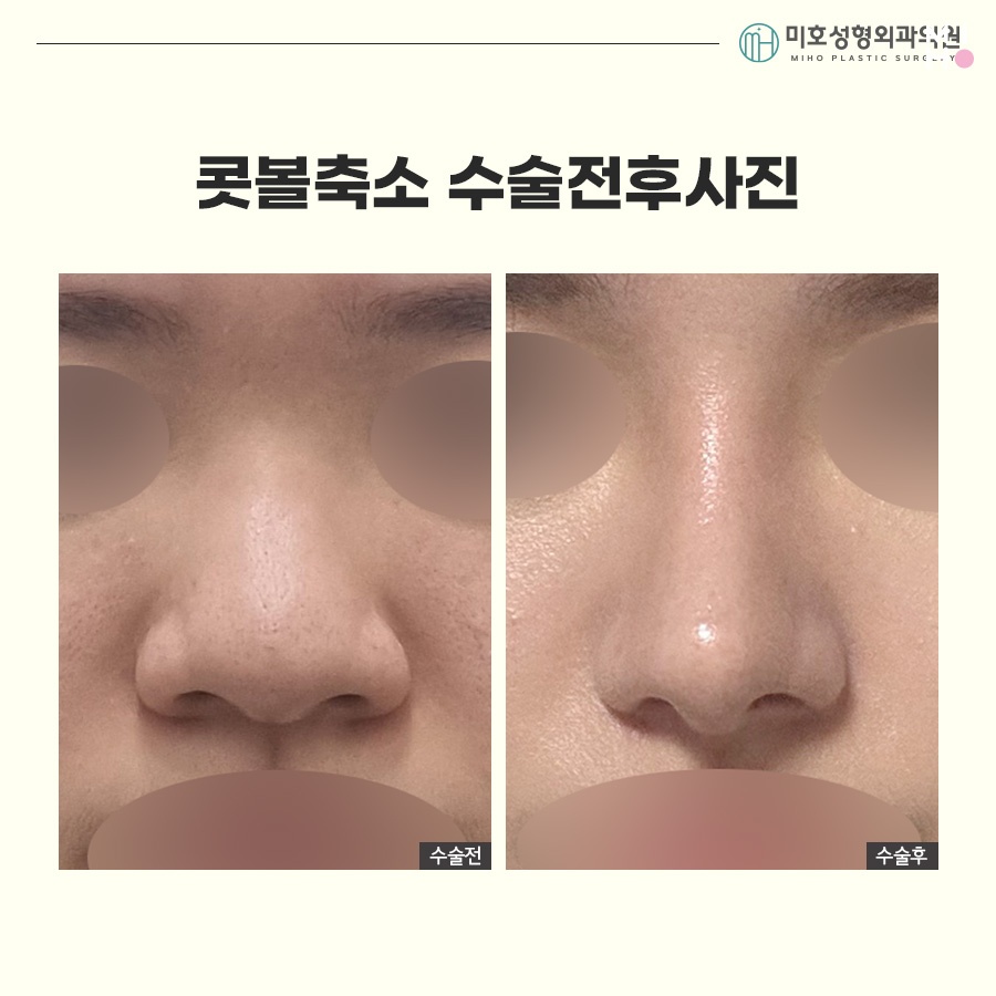 How to Make Your Nostrils Look Smaller: Considering Facial Harmony image 9