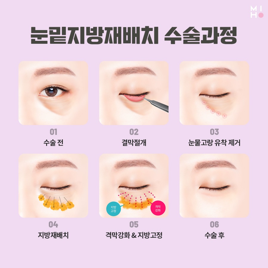 눈밑지방재배치 보완할 곳을 파악하여 관련 이미지 3