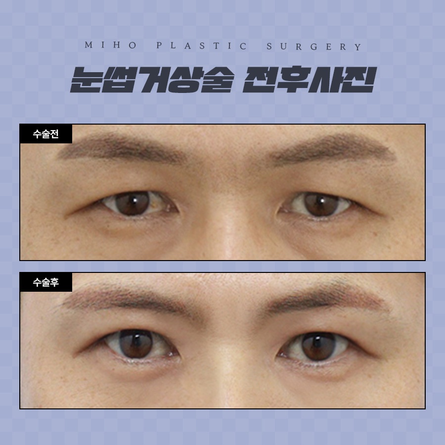 눈썹거상술 잘못된 오해와 장단점 관련 이미지 7