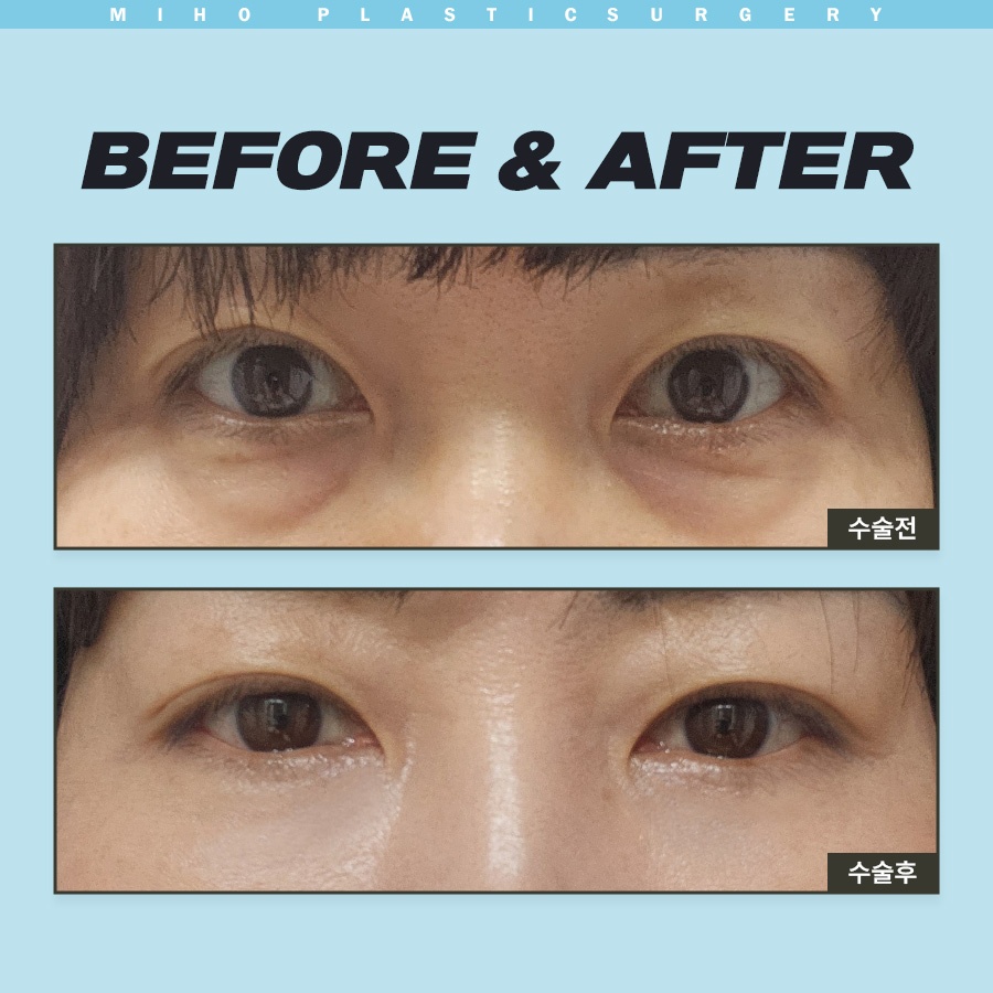 눈밑지방제거 하안검 다크써클 개선 방법 관련 이미지 7