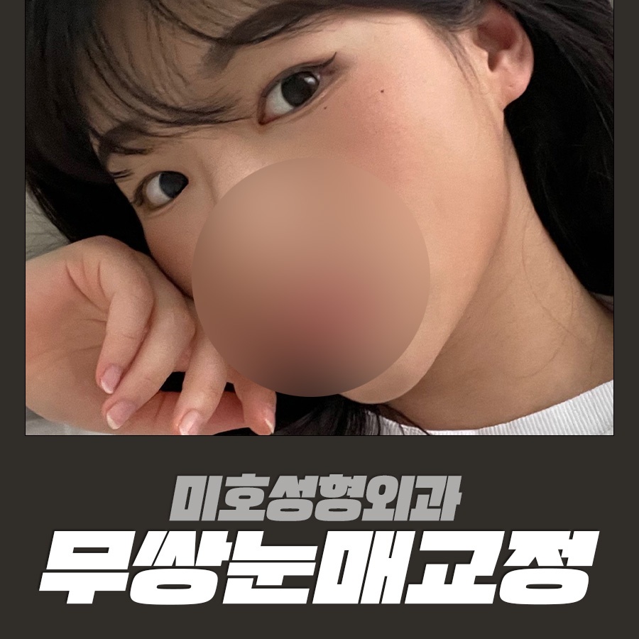 무쌍눈매교정 상황에 따른 개선법 관련 이미지 1