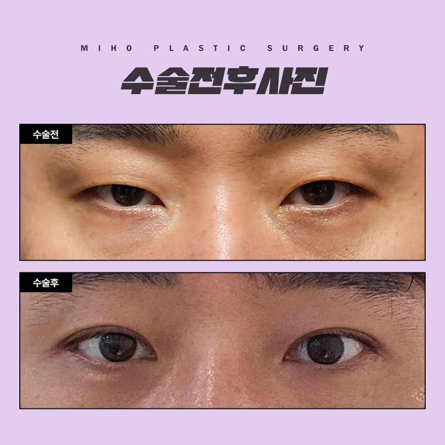 The Key to a Natural Image Transformation with Male Eyelid Surgery image 10