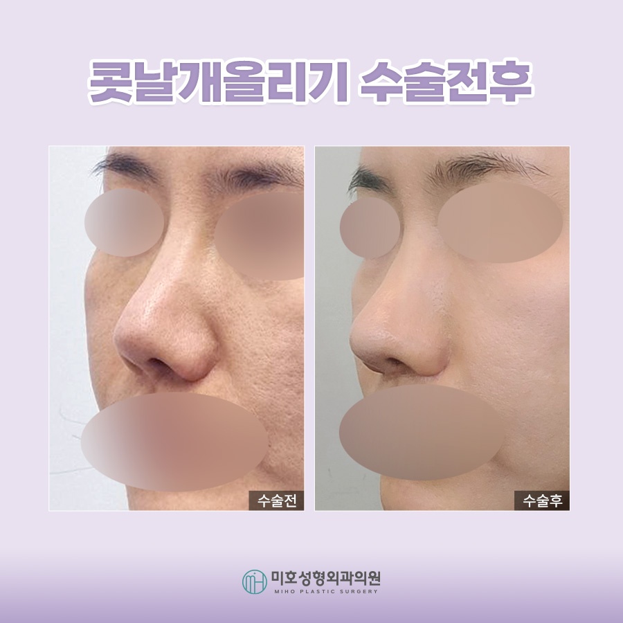 콧날개올리기 개개인에게 맞는 방식으로 관련 이미지 8