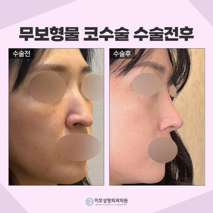 무보형물코수술 자연스러운 라인을 원한다면 관련 이미지 9