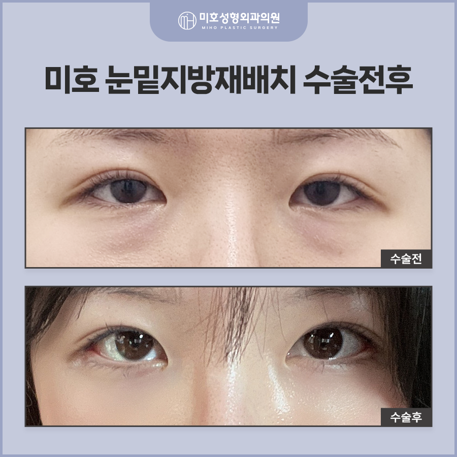Improving Dark Circles Under the Eyes with Under-Eye Fat Repositioning to Create a More Vibrant Eye Area image 7