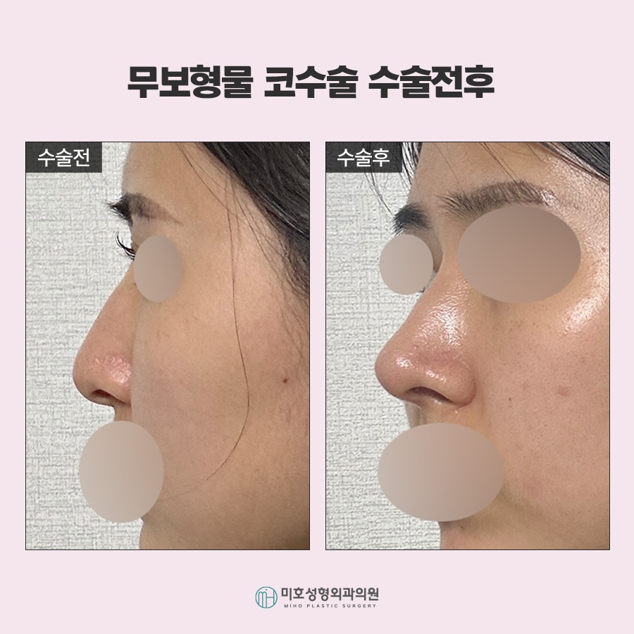 무보형물코수술 자연스러운 코라인을 위한 재료 선택과 확인사항 관련 이미지 10