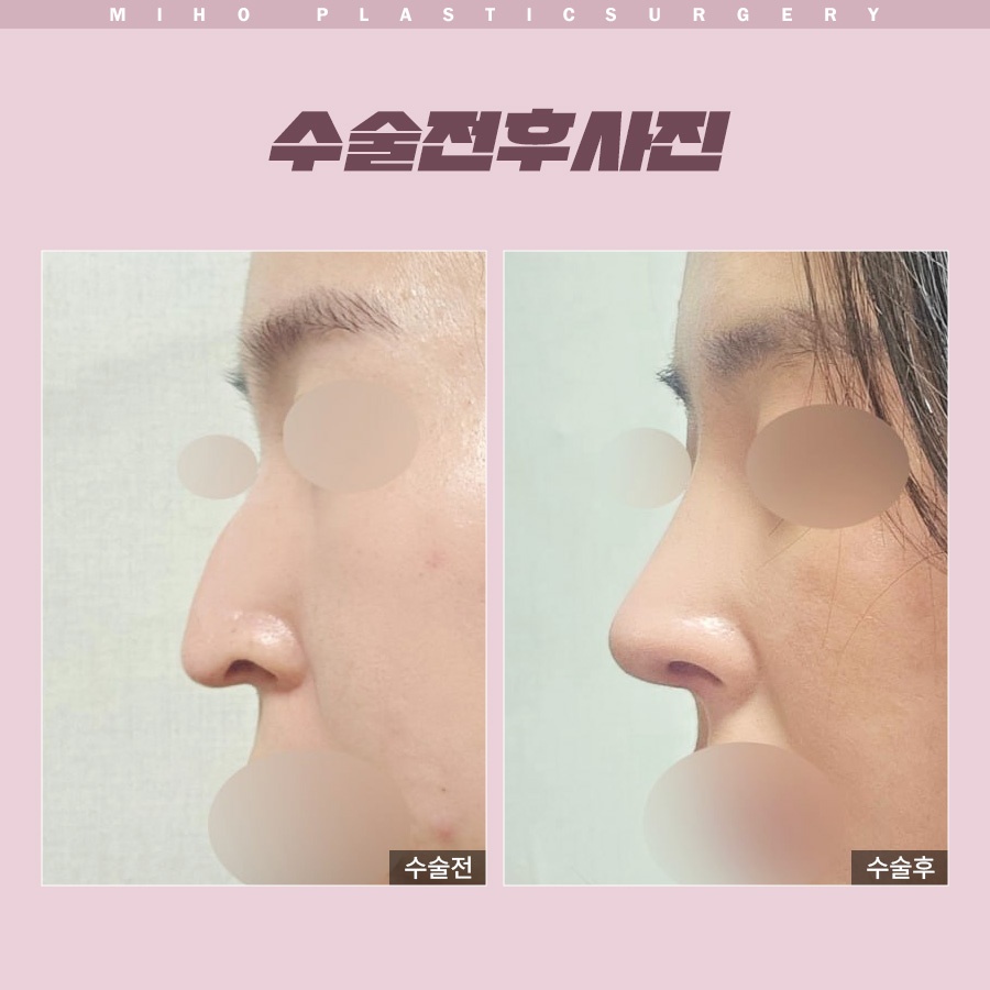 화살코 개선 전 체크리스트 6가지 관련 이미지 8