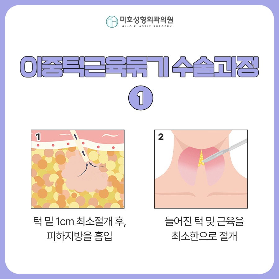 Looking at the Progress of Chin Muscle Ligation for a Double Chin image 3