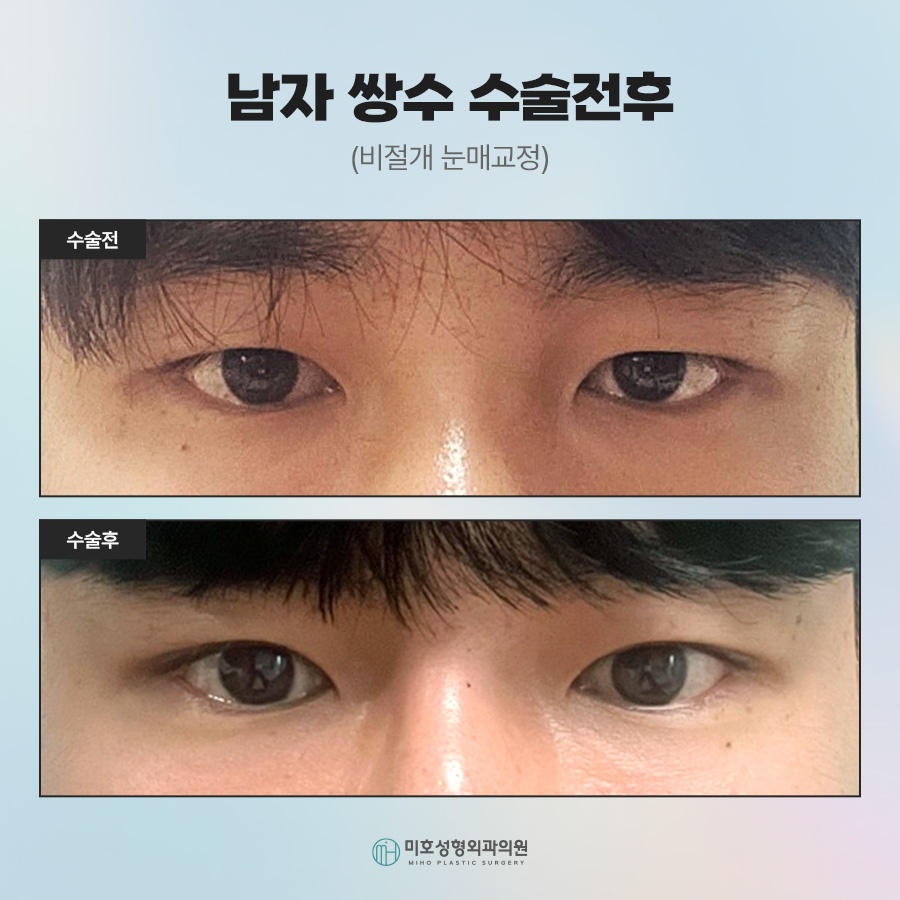 What Men Considering Double Eyelid Surgery Should Know image 6