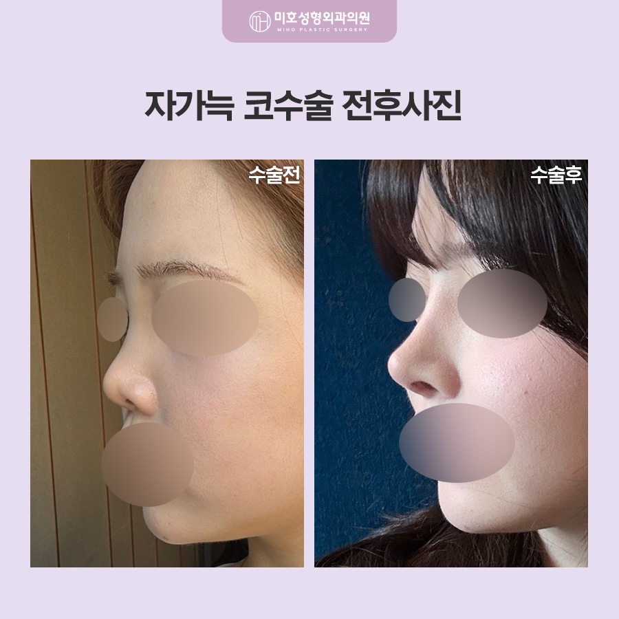 자가늑코수술 흉터와 통증이 걱정된다면 관련 이미지 7