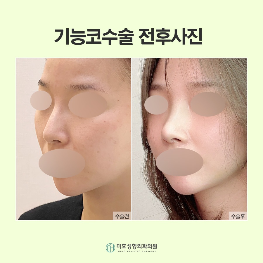 비밸브재건술 기능을 회복시키며 관련 이미지 7